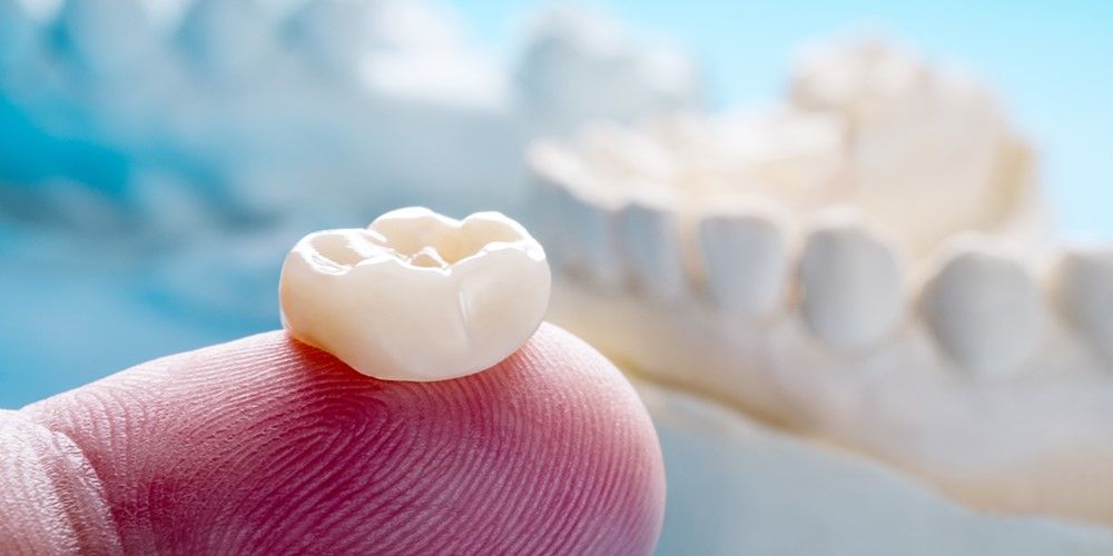 فرق لمینت ونیر کامپوزیت و روکش دندان چیست؟