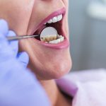 رفع و از بین بردن زردی و بدرنگی کامپوزیت دندان ها