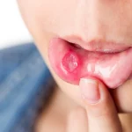 روش درمان موکوسل دهان چیست ؟